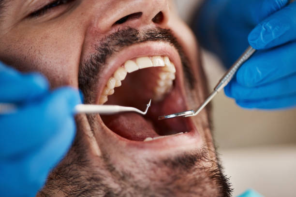 Best Emergency Wisdom Teeth Removal in Mked Tree, AR